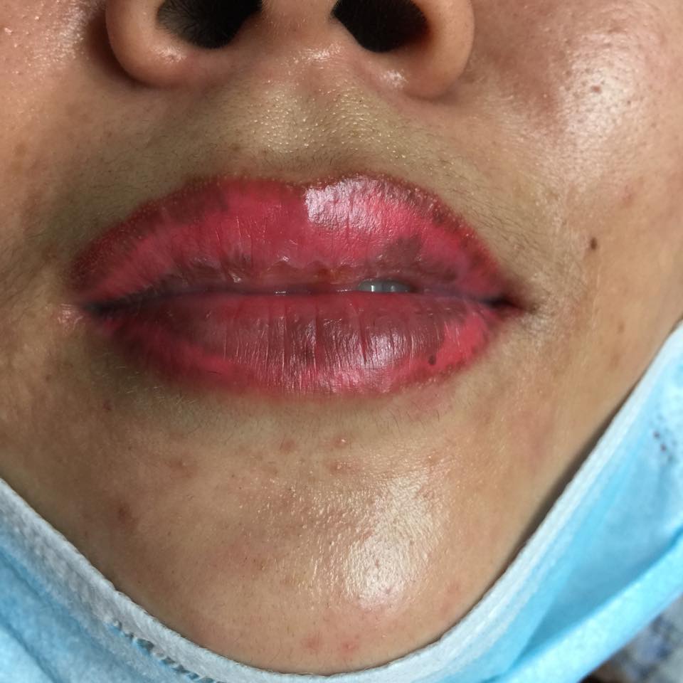 M&ocirc;i chảy mủ v&igrave; &lsquo;nhắm mắt&rsquo; nghe dụ dỗ đi phun xăm