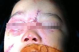 Tr&ecirc;u ch&oacute; qu&aacute; đ&agrave;, b&eacute; trai 3 tuổi bị cắn r&aacute;ch mặt 