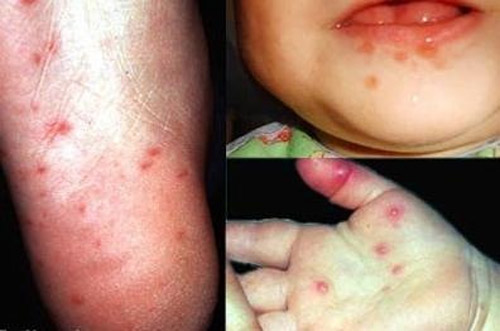 Đ&atilde; c&oacute; 5 ca tử vong do tay ch&acirc;n miệng