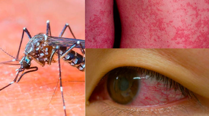 Bộ Y tế họp khẩn cấp ph&ograve;ng chống vi r&uacute;t Zika g&acirc;y teo n&atilde;o