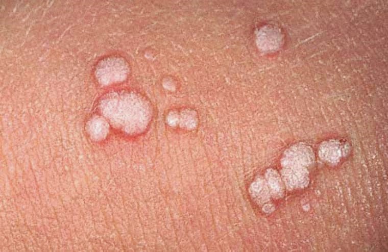 L&acirc;y s&ugrave;i m&agrave;o g&agrave; v&igrave; mặc chung quần l&oacute;t