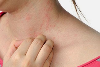 Mẩn ngứa l&acirc;u c&oacute; thể l&agrave; triệu chứng của ung thư da