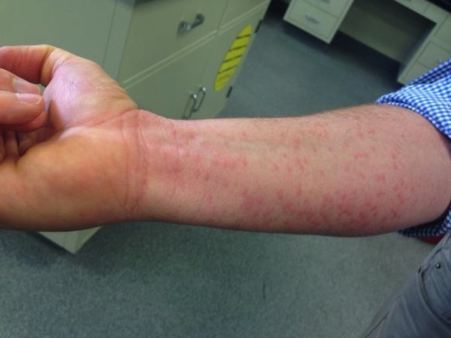 Kh&aacute;nh H&ograve;a: Nguy cơ l&acirc;y nhiễm virus  Zika rất lớn