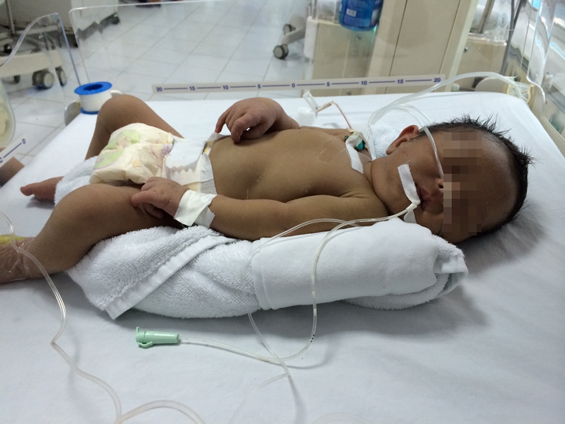 Ngộ độc s&aacute;i thuốc phiện, trẻ sơ sinh 20 ng&agrave;y tuổi v&agrave;o viện cấp cứu