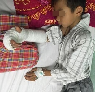 Bệnh viện Nhi Trung ương nối b&agrave;n tay bị ch&eacute;m gần đứt l&igrave;a cho b&eacute; trai 8 tuổi