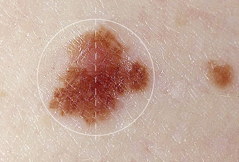 Nh&igrave;n nốt ruồi chẩn đo&aacute;n ung thư