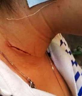 M&ocirc;̣t trong s&ocirc;́ nhi&ecirc;̀u v&ecirc;́t thương tr&ecirc;n người nạn nh&acirc;n 