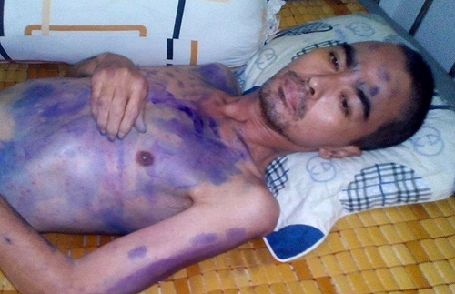 Nguyễn Ho&agrave;ng &lsquo;lao đao&rsquo; v&igrave; l&ecirc;n cơn sốt li b&igrave;