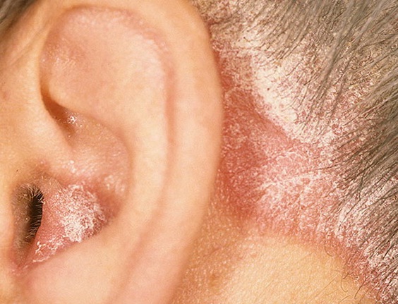 Mặc d&ugrave; c&oacute; t&aacute;c dụng tốt trong việc điều trị nấm, nhưng thuốc miconazole cũng g&acirc;y ra c&aacute;c t&aacute;c dụng phụ đ&aacute;ng sợ 