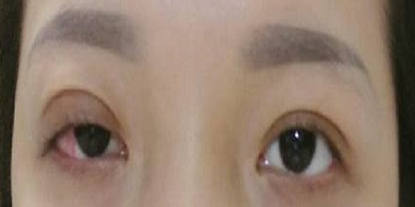 Nhấn m&iacute; l&agrave;m đẹp, c&ocirc; g&aacute;i vĩnh viễn kh&ocirc;ng thể nhắm được mắt