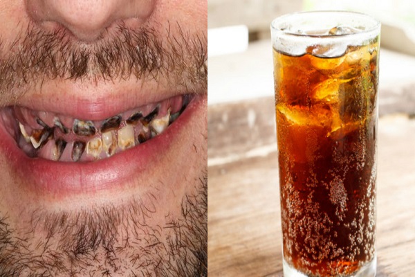'Thối' hết cả h&agrave;m răng v&igrave; uống 'qu&aacute; đ&agrave;' loại nước phổ biến n&agrave;y