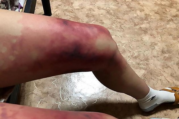 Diện v&aacute;y ngắn trong thời tiết &acirc;m 40 độ, c&ocirc; g&aacute;i su&yacute;t mất đ&ocirc;i ch&acirc;n