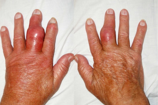 Gia tăng nguy cơ mắc bệnh g&uacute;t do ăn uống, nhậu nhẹt dịp Tết