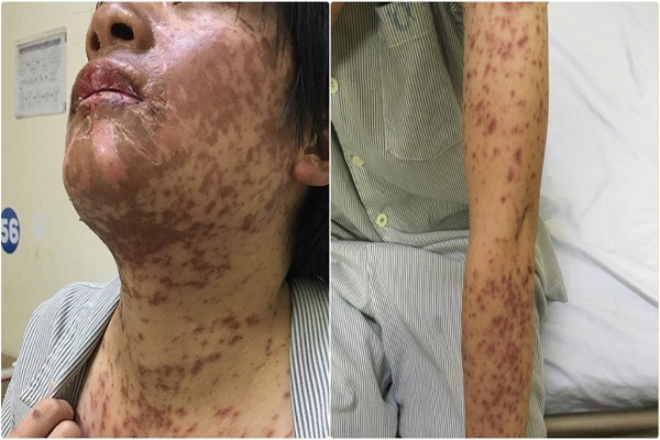Tự mua thuốc trị sốt, đau đầu uống, c&ocirc; g&aacute;i bị biến dạng khu&ocirc;n mặt
