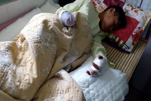 Mất cả b&agrave;n tay, vỡ bụng v&igrave; do ph&aacute;o nổ