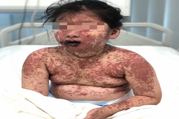 B&eacute; g&aacute;i 7 tuổi c&oacute; l&agrave;n da như 'bỏng nặng' v&igrave; dị ứng thuốc