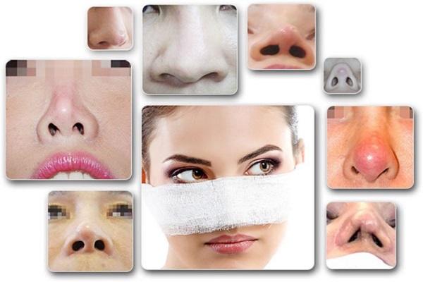 Trước khi n&acirc;ng mũi h&atilde;y biết đến những biến chứng n&agrave;y để c&acirc;n nhắc