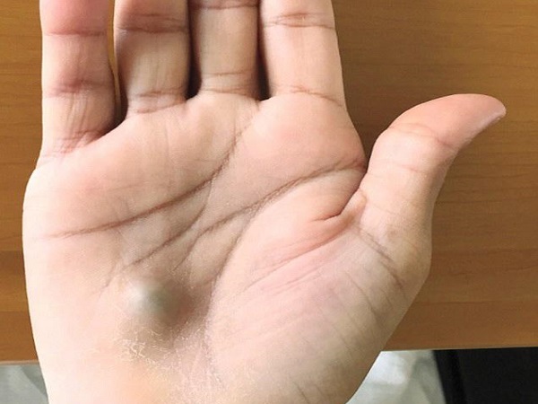 Lười vệ sinh răng miệng, người đ&agrave;n &ocirc;ng bỗng bị căn bệnh kỳ lạ