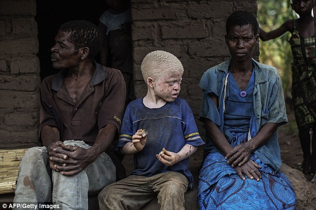 Cậu b&eacute; bị bệnh bạch tạng ngồi b&ecirc;n ba mẹ m&igrave;nh ở Malawi. Ảnh: AFP