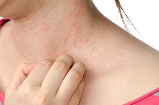 Không nên lạm dụng thuốc giải độc gan khi bị mề đay, mẩn ngứa Không nên lạm dụng thuốc giải độc gan khi bị mề đay, mẩn ngứa