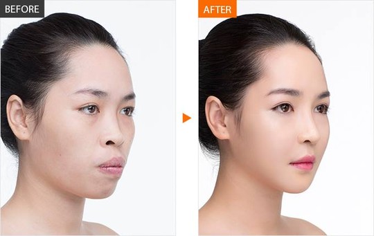 đổi đời nhờ phẫu thuật thẩm mỹ 
