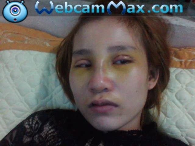 phẫu thuật thẩm mỹ hỏng