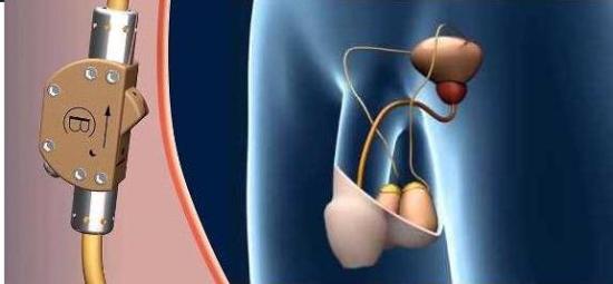 Van kh&oacute;a tinh tr&ugrave;ng l&agrave; ph&aacute;t minh mới ấn tượng gi&uacute;p tr&aacute;nh thai