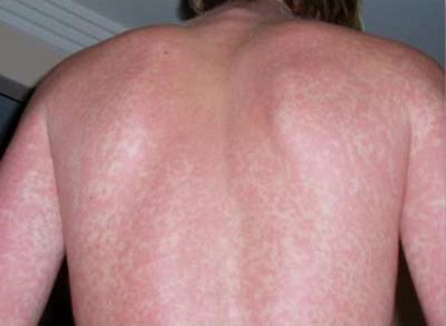 Ph&aacute;t ban thường xuất hiện v&agrave;o cuối chu kỳ của bệnh