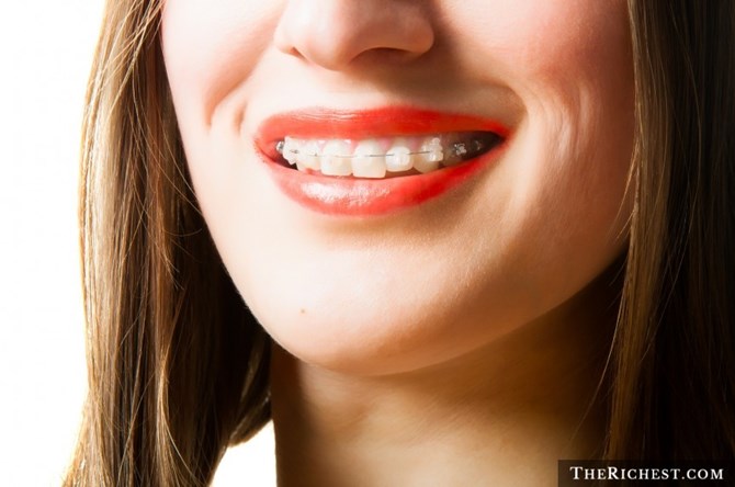Niềng răng trong suốt c&oacute; t&iacute;nh thẩm mỹ cao hơn, người đeo sẽ đỡ bị ch&ecirc; xấu hơn khi 