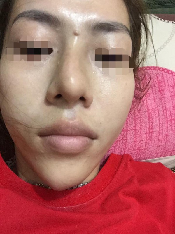 H&agrave;ng loạt trường hợp thẩm mỹ bị vẹo m&ocirc;i, mũi, lệch cằm. 