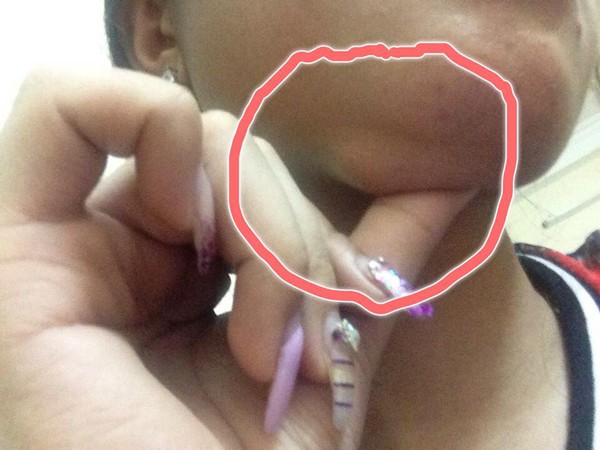 H&agrave;ng loạt chị em 'cằm m&eacute;o, mắt trợn' do ti&ecirc;m chất l&agrave;m đầy dởm