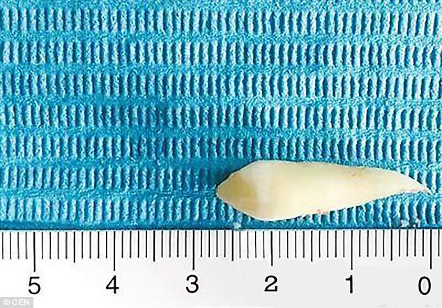 Chiếc răng nanh dài 3cm được bác sĩ loại bỏ. Ảnh: QQ