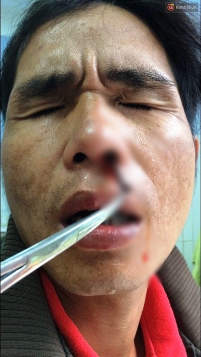 B&aacute;c sĩ đang gắp con đỉa sống trong mũi &ocirc;ng Chơ ra ngo&agrave;i