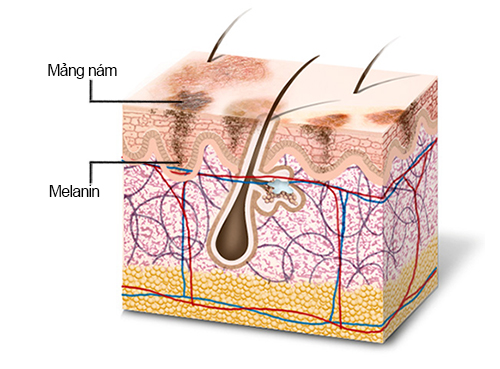 Sạm da mặt ở nữ giới gây mất thẩm mỹ