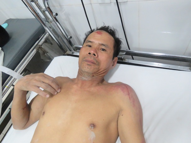 Nạn nh&acirc;n Nguyễn Văn Cao đang điều trị tại bệnh viện sau vụ tai nạn sập gi&agrave;n gi&aacute;o