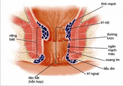 T&aacute;c dụng của dầu dừa cũng được &aacute;p dụng triệt để trong điều trị bệnh trĩ