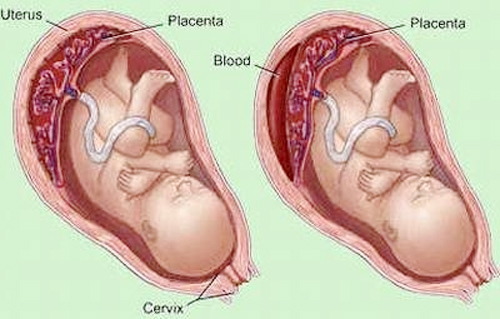 B&agrave; bầu c&oacute; thể bị bong rau non nếu mắc phải bệnh sốt xuất huyết trong thai kỳ