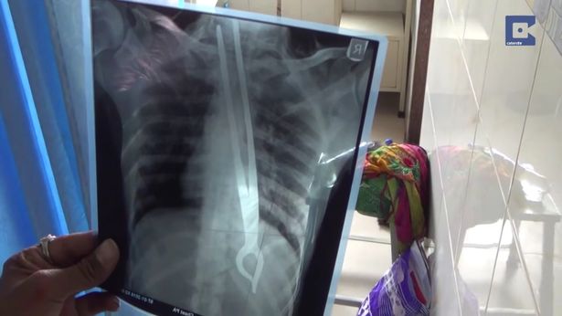 Tai nạn hy hữu này khiến nam thanh niên 27 tuổi suýt mất mạng Tai nạn hy hữu này khiến nam thanh niên 27 tuổi suýt mất mạng
