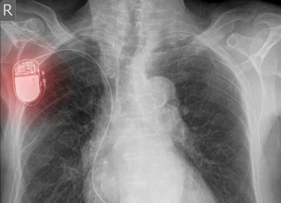 C&aacute;c thiết bị cấy gh&eacute;p kh&ocirc;ng d&acirc;y gi&uacute;p b&aacute;c sĩ dễ d&agrave;ng kiểm so&aacute;t c&aacute;c chứng bệnh
