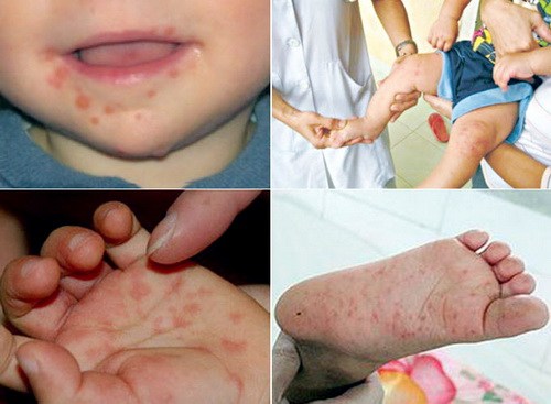 Tay ch&acirc;n miệng l&agrave; bệnh thường gặp v&agrave;o m&ugrave;a h&egrave; ở trẻ nhỏ