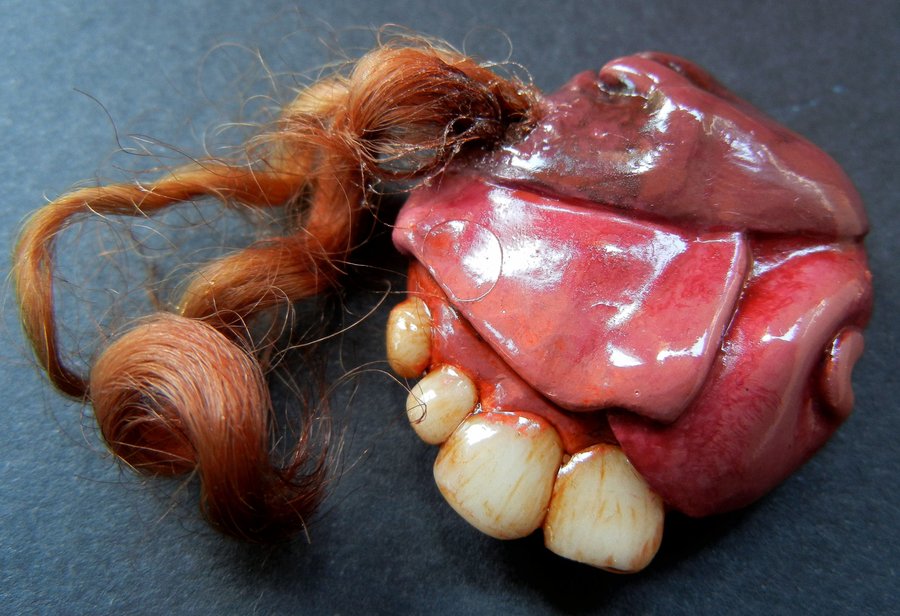 H&igrave;nh ảnh một u qu&aacute;i Teratoma trong n&atilde;o người