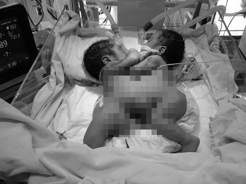 2 b&eacute; song sinh d&iacute;nh liền tổn thương tim phức tạp đ&atilde; ra đi m&atilde;i m&atilde;i l&agrave; một trong những tin tức nổi bật 24h qua    