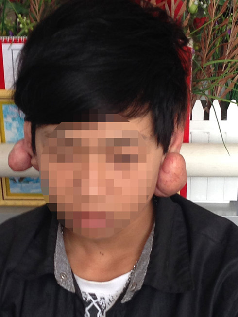 Bệnh nh&acirc;n bị biến chứng sau khi bấm lỗ tai