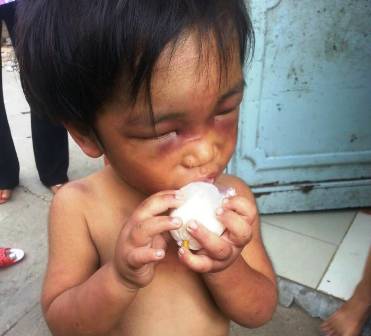Ch&aacute;u Nguyễn Th&agrave;nh ĐỨc 3 tuổi bị đ&aacute;nh bầm dập v&agrave; bắt đi ăn xin