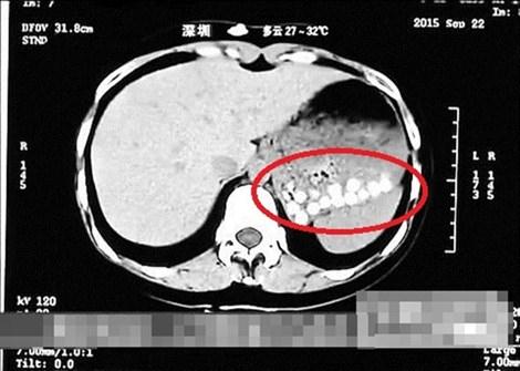 Hạt tr&acirc;n ch&acirc;u kh&ocirc;ng thể ti&ecirc;u h&oacute;a được trong dạ d&agrave;y