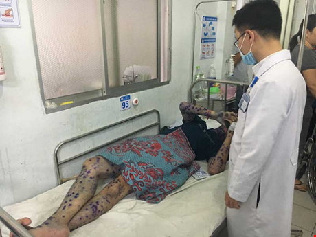 Lại xuất hiện ổ dịch thủy đậu ở TP. Hồ Ch&iacute; Minh