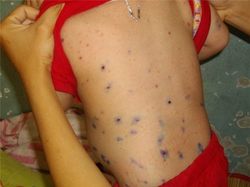 N&ecirc;n ti&ecirc;m vacxin ph&ograve;ng thủy đậu cho trẻ