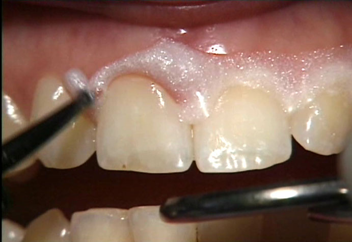 Thuốc tẩy trắng răng kh&ocirc;ng đ&uacute;ng c&aacute;ch c&oacute; thể g&acirc;y tổn thương nướu.