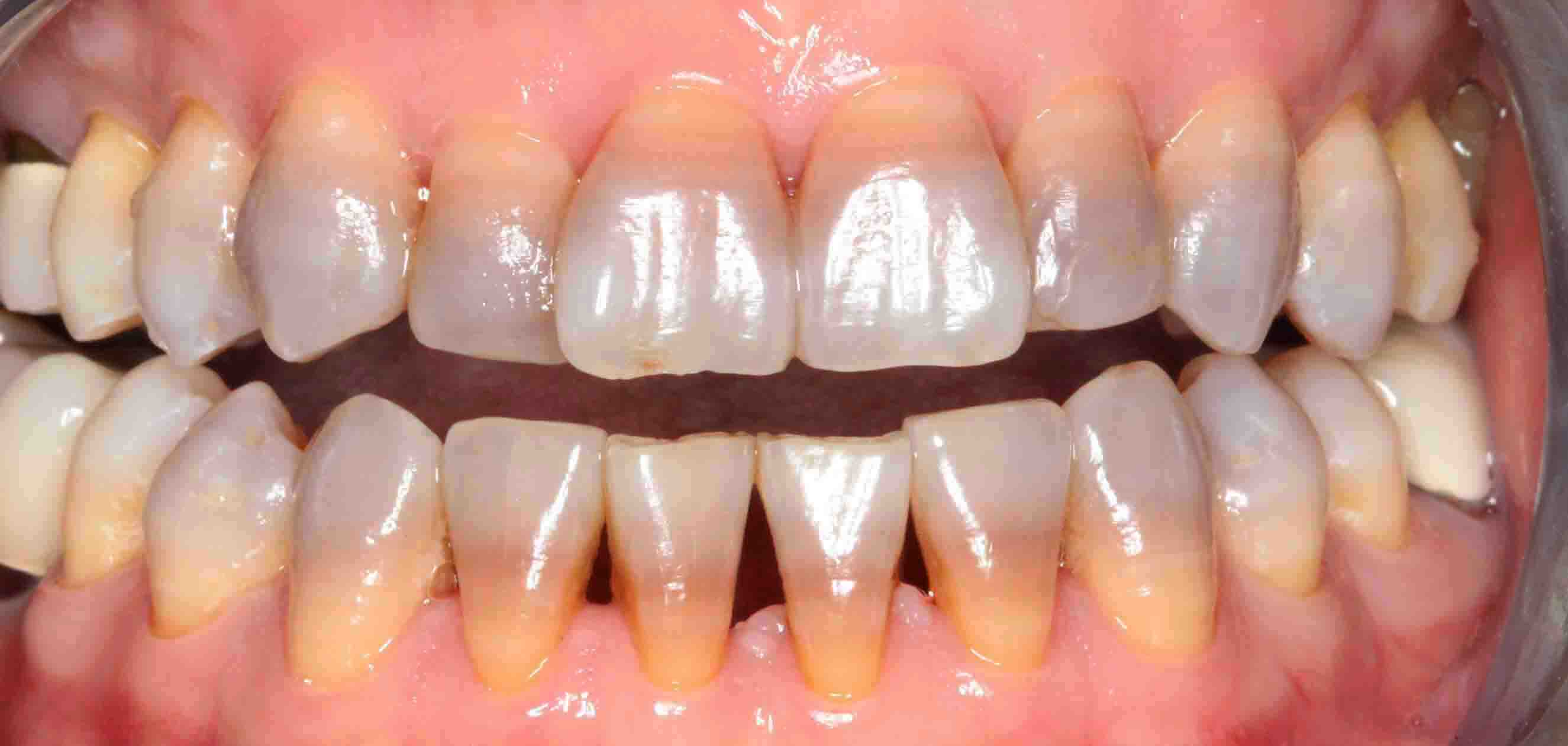 Tẩy trắng răng sai c&aacute;ch tại nh&agrave; c&oacute; thể hủy hoại men răng