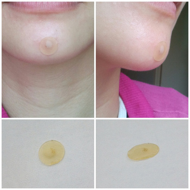Miếng d&aacute;n mụn được nhiều người sử dụng trong thời gian qua